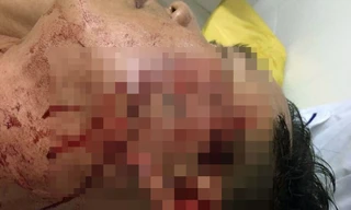  Đại úy công an bị nam thanh niên đánh thương tích trong quán nhậu