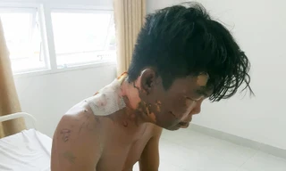 Thanh niên 24 tuổi bị chị gái đổ nồi nước sôi lên đầu