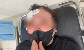 Hà Nội: Một phụ nữ tố bị người đi ô tô dùng dùi cui đập vào đầu vì không tránh đường