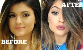 Tại sao mọi người đều tiêm filler làm đầy môi? Những khao khát dấu đằng sau mốt môi dày