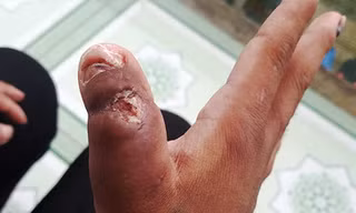Vết thương tàn ác mà bà Hà gây ra cho chị Y Nhiêu