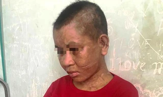 Chị Y Nhiêu bị đánh đập với nhiều vết thương khắp người