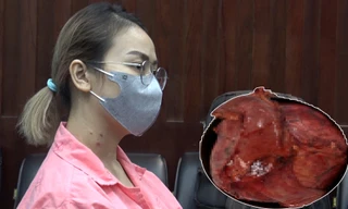 Bệnh nhân bị khối u tụy khổng lồ.