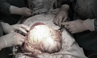 Bác sĩ phẫu thuật cắt khối u 'khủng' cho bệnh nhân.