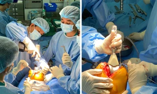 Các bác sĩ phẫu thuật thay khớp gối cho bệnh nhân.