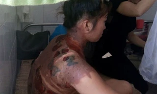 Chị V. với nhiều vết bỏng khắp cơ thể. Ảnh: Lam Sơn.