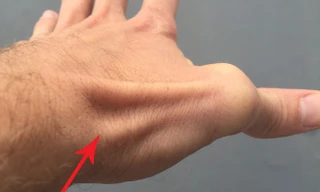 Tay bạn có tồn tại vết lõm này không?