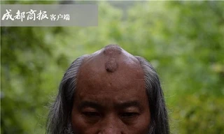 Đầu ông Hà Đạo Quân nổi nốt chai do nhiều năm luyện Thiết Đầu Công. Ảnh: Chengdu Shangbao.