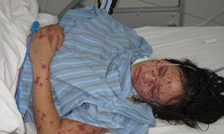 60 nghìn liều vắc xin phòng não mô cầu A, C sắp về Việt Nam