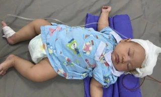 Cháu bé bị dao đâm xuyên đầu đã tự thở, tự bú được