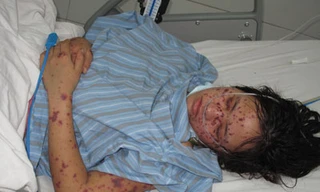 Các ban đỏ điển hình của bệnh nhân viêm não mô cầu. (Ảnh minh hoạ)