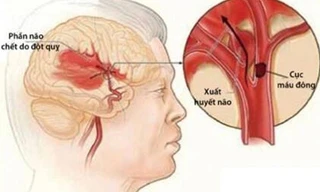 Mỗi giờ có 12 người chết vì đột quỵ