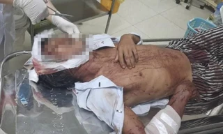 Nạn nhân hiện đang được cấp cứu tại BVĐK tỉnh Bình Định.