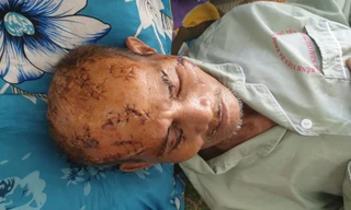 Chằng chịt vết thương trên đầu ông T. Ảnh: A.T