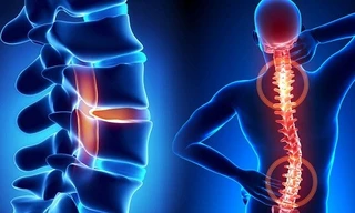 Bí quyết vàng cho bệnh nhân xương khớp