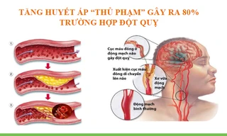  Xu hướng mới trong điều trị tăng huyết áp và phòng ngừa đột quỵ