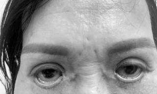 Tin lầm lang băm cắt mí 'chui', người phụ nữ khóc thét vì đôi mắt trợn ngược 