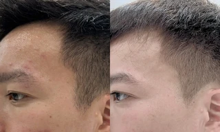 Hành trình hết mụn, sẹo của Hoàng Đức: Khi phong độ và diện mạo cùng tỏa sáng