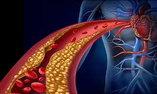 Tiểu đường, mỡ máu được coi là hai “sát thủ” âm thầm đối với người bệnh.