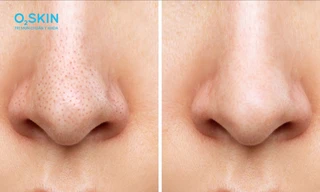 Cách trị mụn đầu đen hiệu quả: Những việc nên và không nên làm