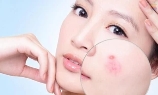 Serum tái tạo da Hoàng Thiên Sâm giải quyết mọi vấn đề của da mụn