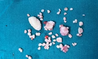 Gắp 50 viên 'sỏi' khỏi khớp khuỷu tay cho bệnh nhân mắc bệnh hiếm tỷ lệ 1/100.000 ca