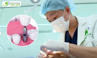 Kỹ thuật trồng răng Implant flapless tại nha khoa Thùy Anh