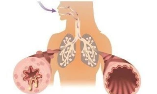 Bảo Phế Vương - 'Xua tan' nỗi lo ho lâu ngày uống kháng sinh không khỏi