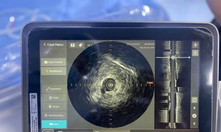  Cấp cứu thành công ca lóc tách động mạch vành nhờ kỹ thuật siêu âm trong lòng mạch