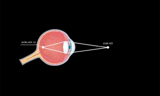 Cơ chế tạo ảnh trên võng mạc. Khi điểm hội tụ ảnh nằm trước võng mạc, đó là cận thị