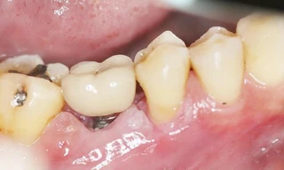 Giắt thức ăn sau khi trồng răng implant - Bài toán đã có lời giải
