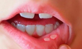 Nhiệt miệng, nhiệt lưỡi, nhiệt lợi tái phát – Xem ngay giải pháp