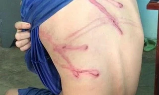 Cháu Phát bị cha dùng dây điện đánh gây thương tích khắp cơ thể.