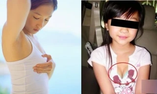 Ngực to bất thường, dấu hiệu dậy thì sớm của trẻ