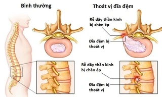 Giải pháp vàng từ bài thuốc Đông y cổ truyền điều trị thoát vị đĩa đệm