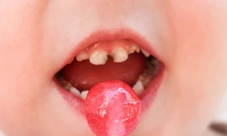 Tầm quan trọng của răng sữa, điều ít mẹ biết