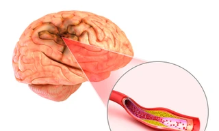 Đột quỵ não và vai trò của chụp cộng hưởng từ (MRI) trong tầm soát đột quỵ