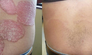 Kiểm soát hiệu quả bệnh vẩy nến bằng kết hợp thảo dược