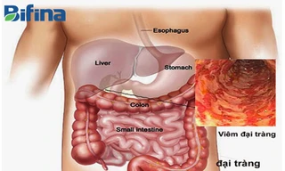 Mách bạn bí kíp hết khổ vì viêm đại tràng 
