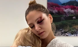 Hoa hậu 25 tuổi gặp tai nạn giao thông nghiêm trọng