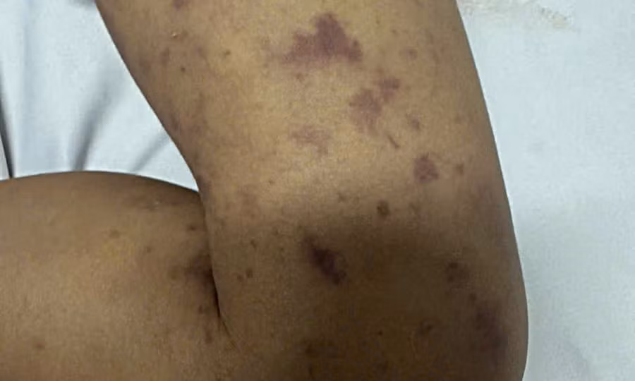 Cháu tử vong do não mô cầu, chú ruột 40 tuổi cũng nhiễm bệnh