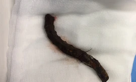 Bị thanh sắt phi 12 đâm xuyên sọ, người đàn ông may mắn thoát chết