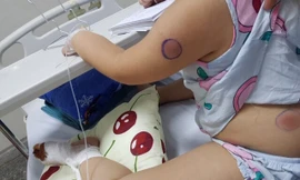 Gà mổ vào chân, bé gái bị nhiễm khuẩn “ăn thịt người”