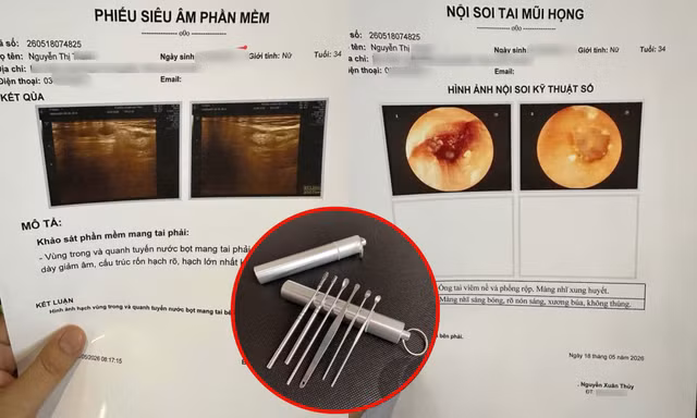 Dùng một loại dụng cụ ngoáy tai quen thuộc, cô gái phải nhập viện điều trị