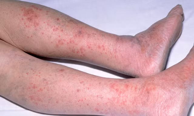 Cảnh báo loại bệnh có thể gây tử vong trong 24h, gia tăng thời điểm giao mùa