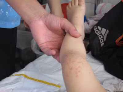 Hơn 15 tỷ đồng cho điều trị bệnh tay chân miệng