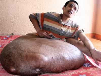 Treo thưởng tìm ra bệnh của người mang khối u 80kg