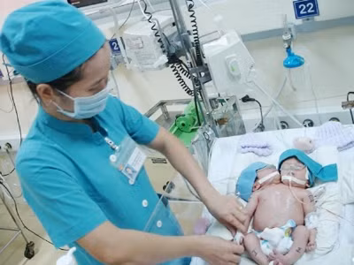 Xác suất thành công tách bé gái hai đầu rất thấp