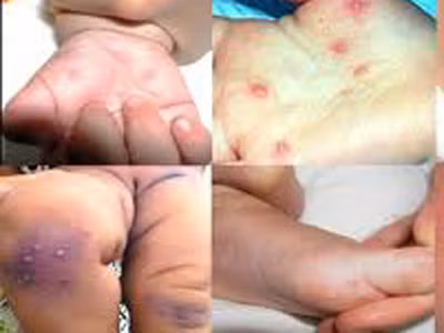 Trẻ mắc tay chân miệng và sốt xuất huyết tăng cao