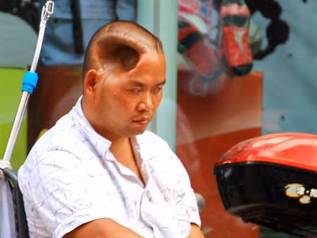 Phi thường người đàn ông sống với lỗ hổng trên đầu